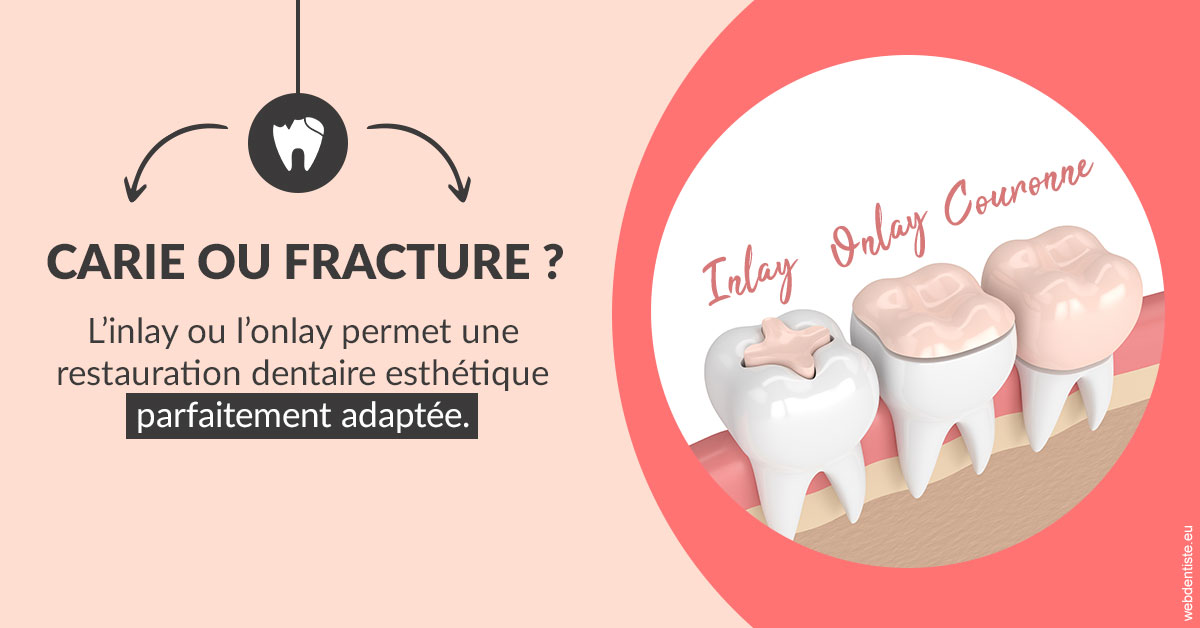https://www.orthodontistenice.com/T2 2023 - Carie ou fracture 2