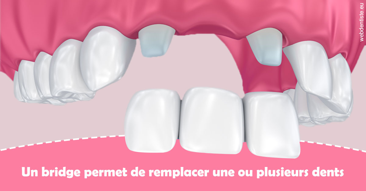 https://www.orthodontistenice.com/Bridge remplacer dents 2
