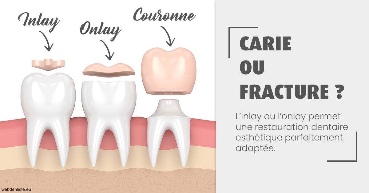 https://www.orthodontistenice.com/T2 2023 - Carie ou fracture 1