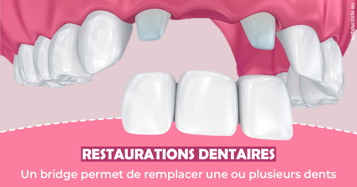https://www.orthodontistenice.com/Bridge remplacer dents 2
