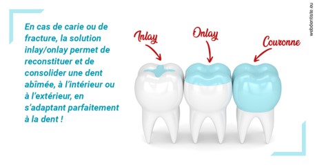 https://www.orthodontistenice.com/L'INLAY ou l'ONLAY