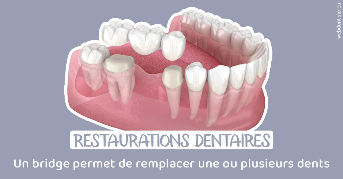 https://www.orthodontistenice.com/Bridge remplacer dents 1
