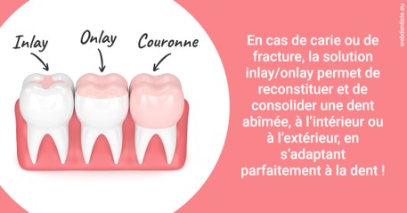 https://www.orthodontistenice.com/L'INLAY ou l'ONLAY 2