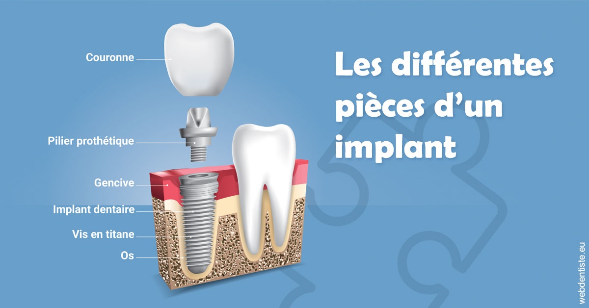https://www.orthodontistenice.com/Les différentes pièces d’un implant 1