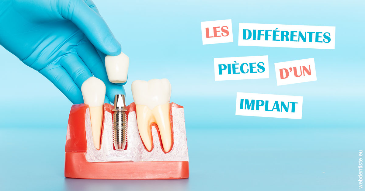 https://www.orthodontistenice.com/Les différentes pièces d’un implant 2