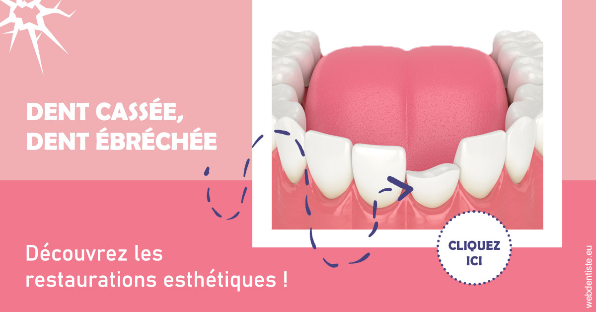 https://www.orthodontistenice.com/Dent cassée ébréchée 1